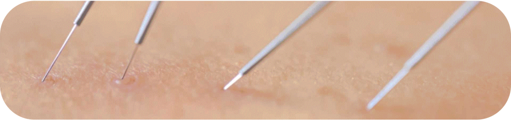 דיקור מערבי